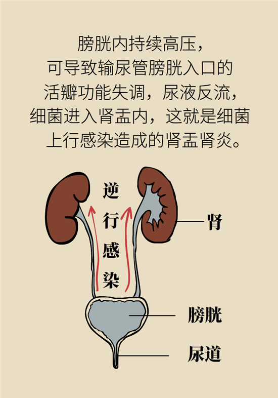 經常憋尿會得急性腎炎？