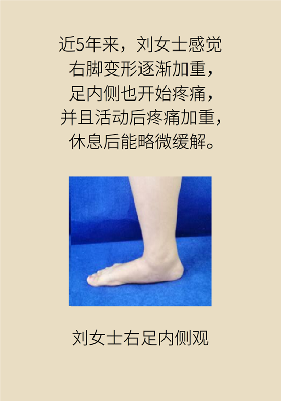 走幾百米路就疼得不行了？可能患上了平足癥