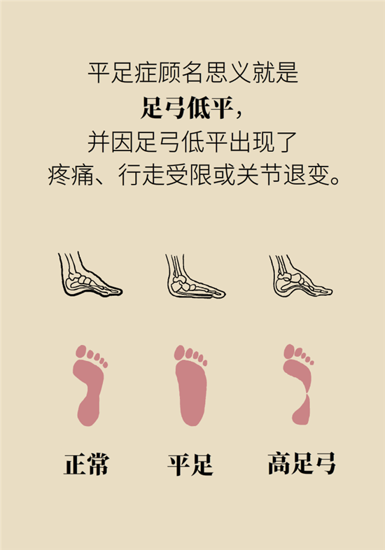 走幾百米路就疼得不行了？可能患上了平足癥