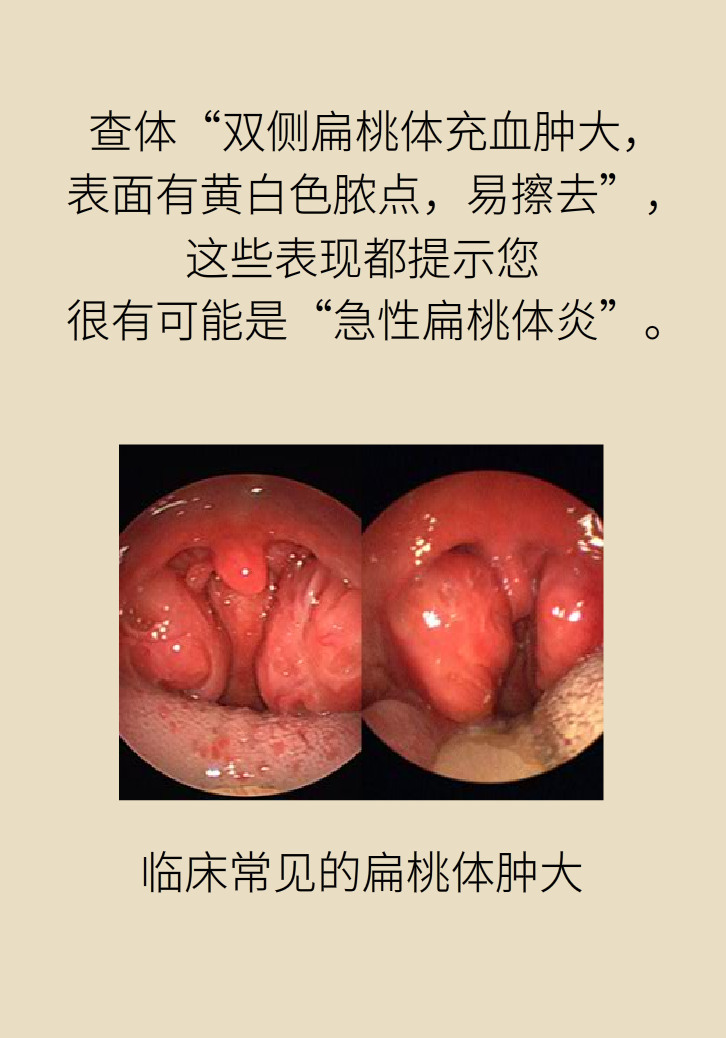 單側(cè)扁桃體腫大更兇險(xiǎn)！謹(jǐn)防惡性腫瘤