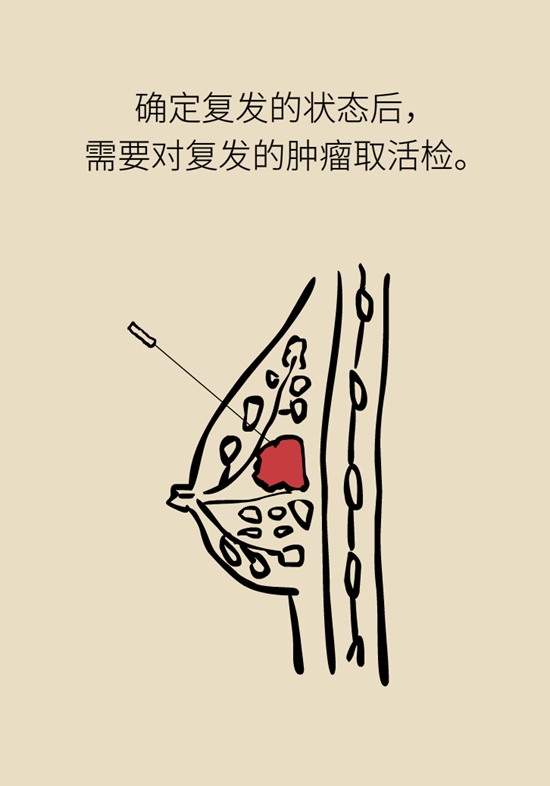 乳腺癌復(fù)發(fā)、轉(zhuǎn)移了怎么辦？