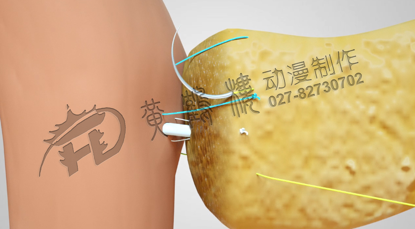 武漢醫(yī)療手術(shù)演示動畫制作.jpg 武漢醫(yī)療手術(shù)演示動畫制作.jpg