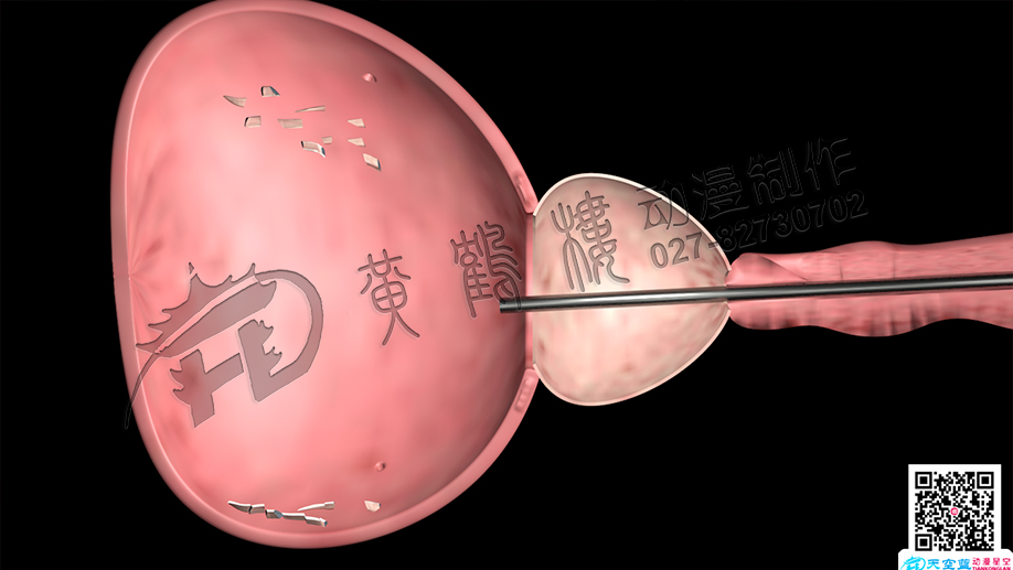 膀胱醫(yī)療動(dòng)畫(huà).jpg