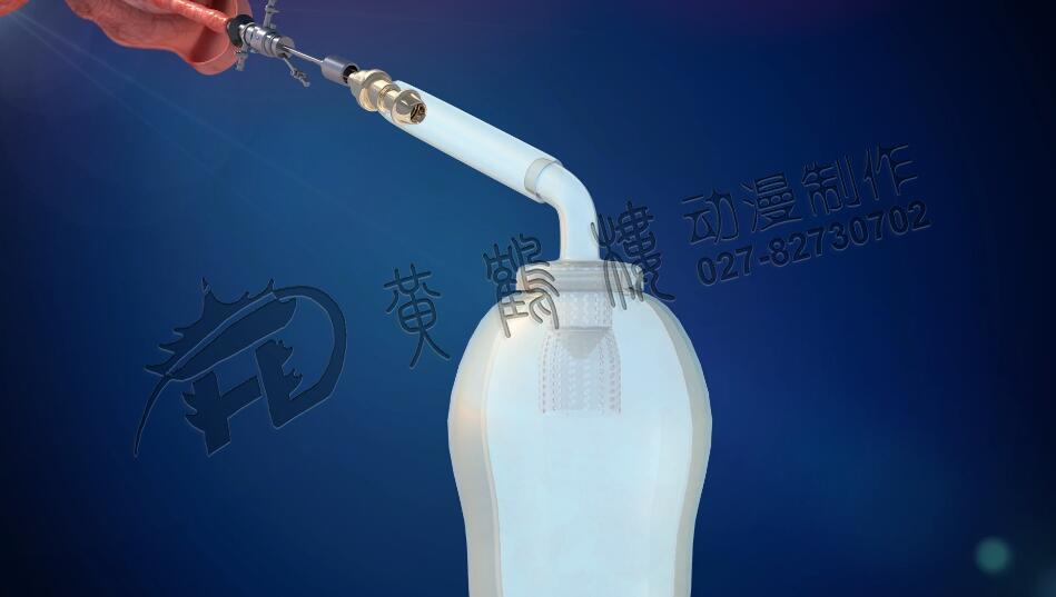 前列腺手術抗反流收集裝置.jpg 前列腺手術抗反流收集裝置.jpg
