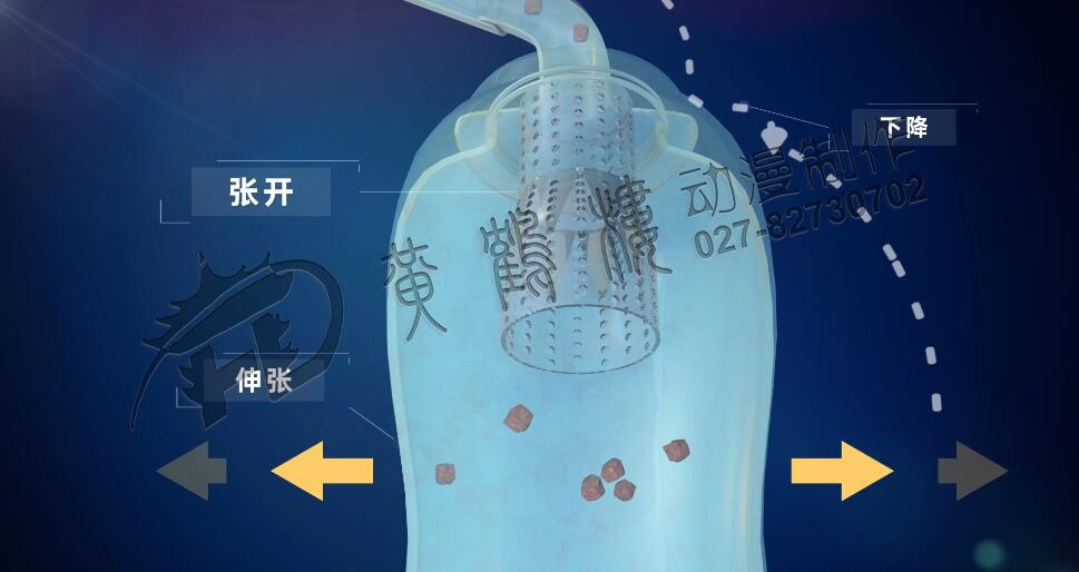 前列腺手術抗反流收集裝置工作原理.jpg 前列腺手術抗反流收集裝置工作原理.jpg