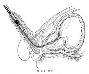 經(jīng)尿道前列腺切除術