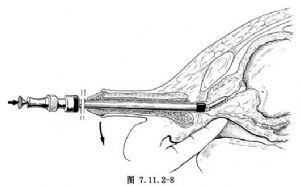 經(jīng)尿道前列腺切除術
