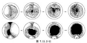 經(jīng)尿道前列腺切除術