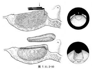 經(jīng)尿道前列腺切除術