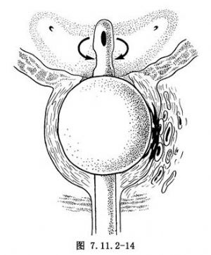 經(jīng)尿道前列腺切除術