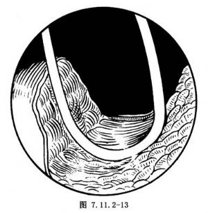 經(jīng)尿道前列腺切除術