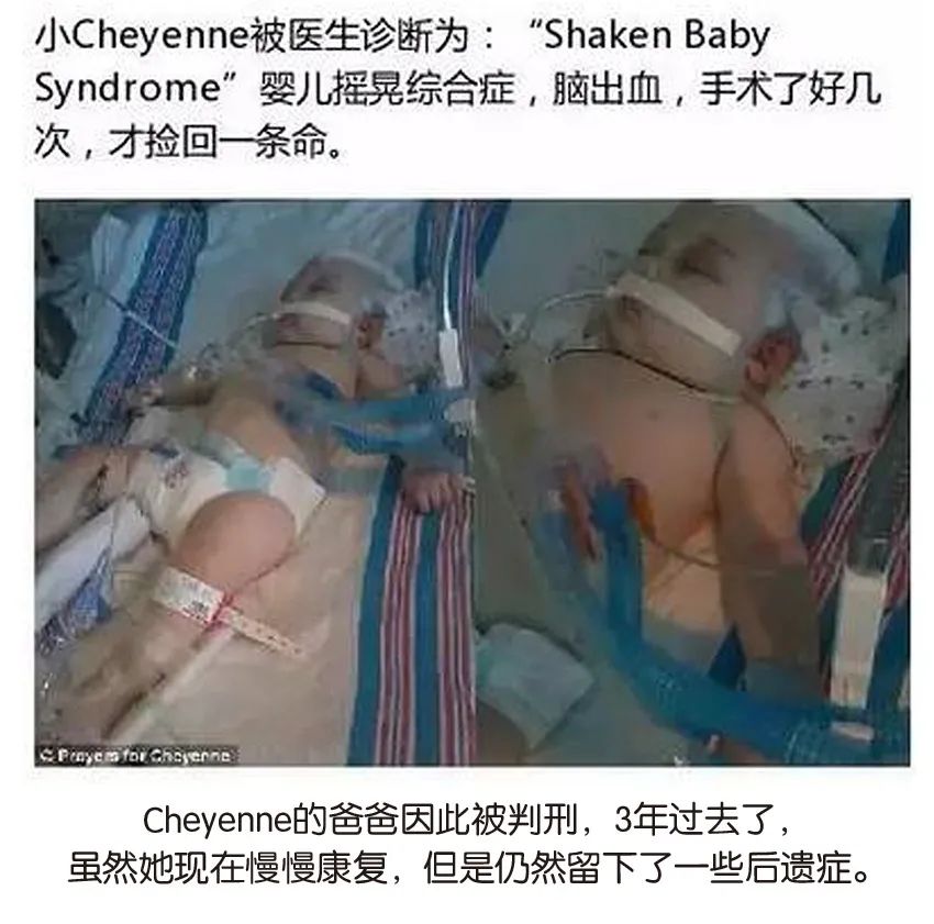 育兒醫(yī)學(xué)科普:大力搖晃會(huì)損傷寶寶的大腦致腦損傷